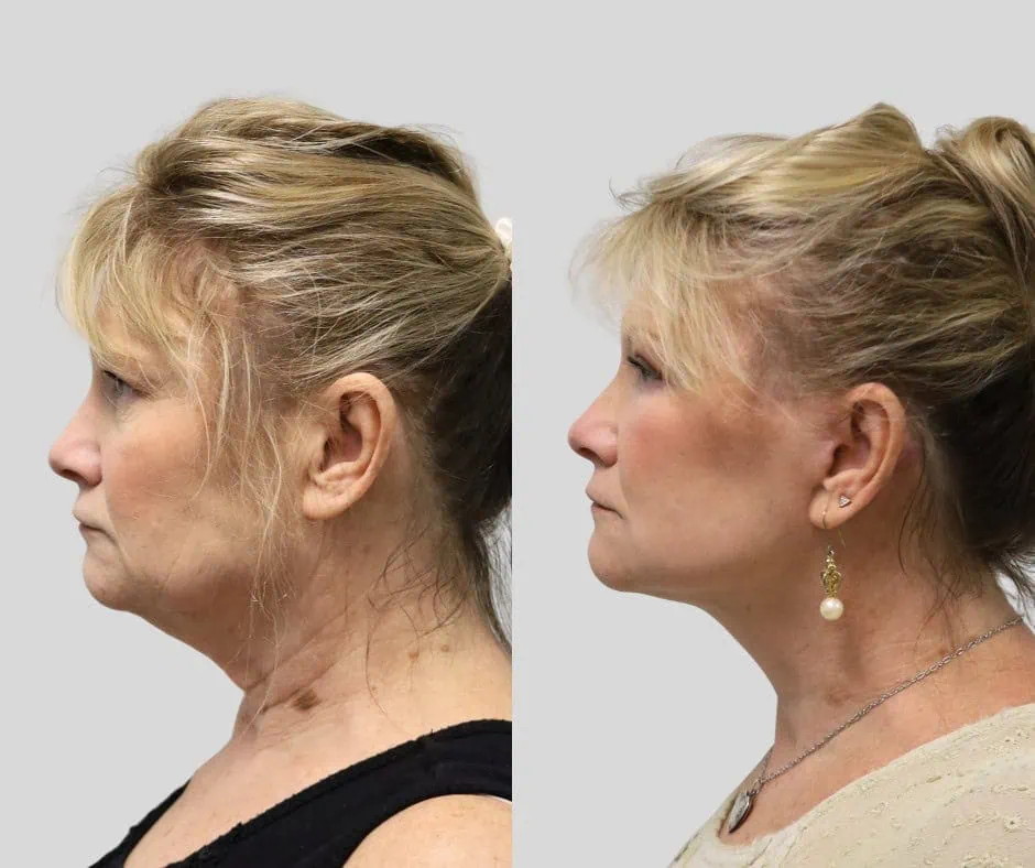 Age 55, left profile, before and after CURRENT Lift with fat grafting, upper blepharoplasty and periocular laser, 1 year post-op