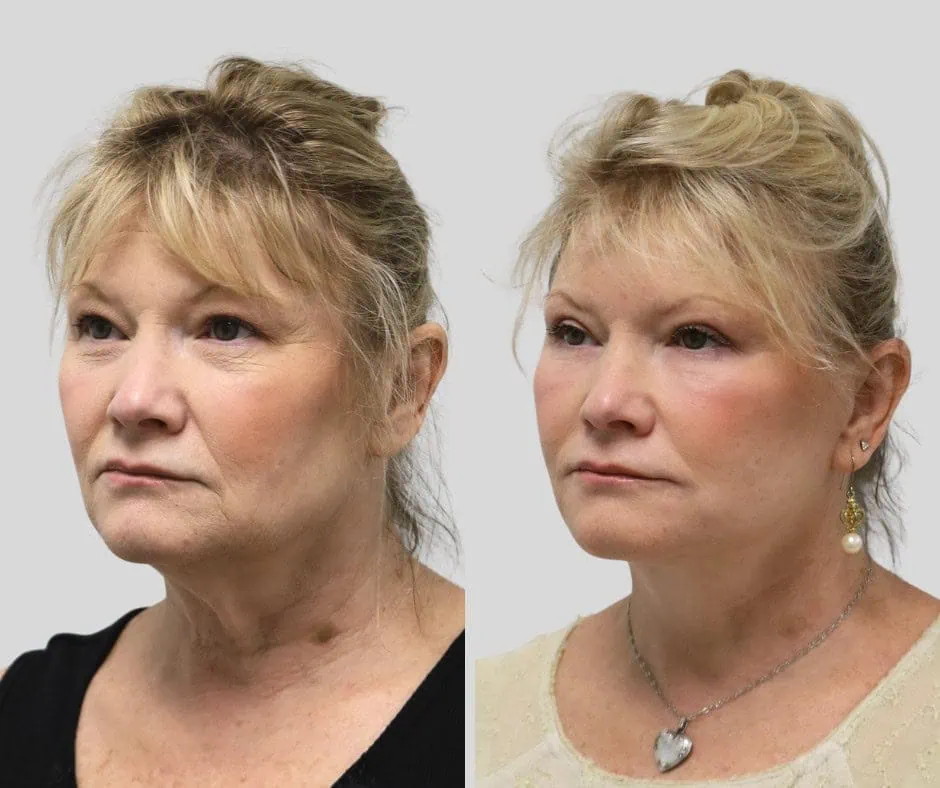 Age 55, left three-quarter view, before and after CURRENT Lift with fat grafting, upper blepharoplasty and periocular laser, 1 year post-op