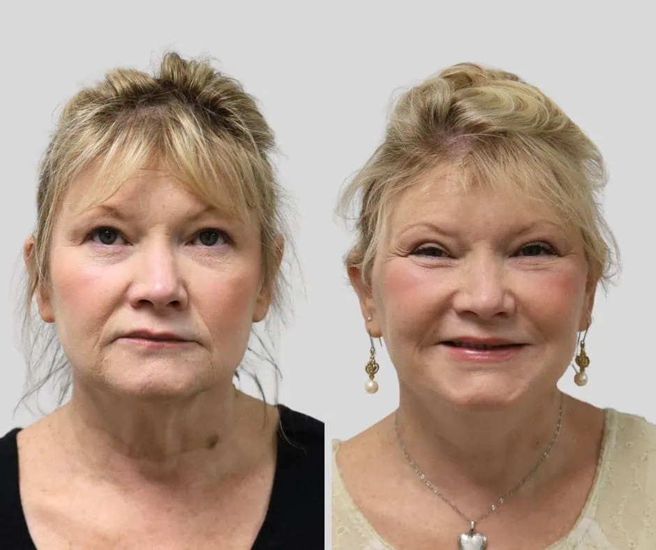 Age 55, front view, before and after CURRENT Lift with fat grafting, upper blepharoplasty and periocular laser, 1 year post-op