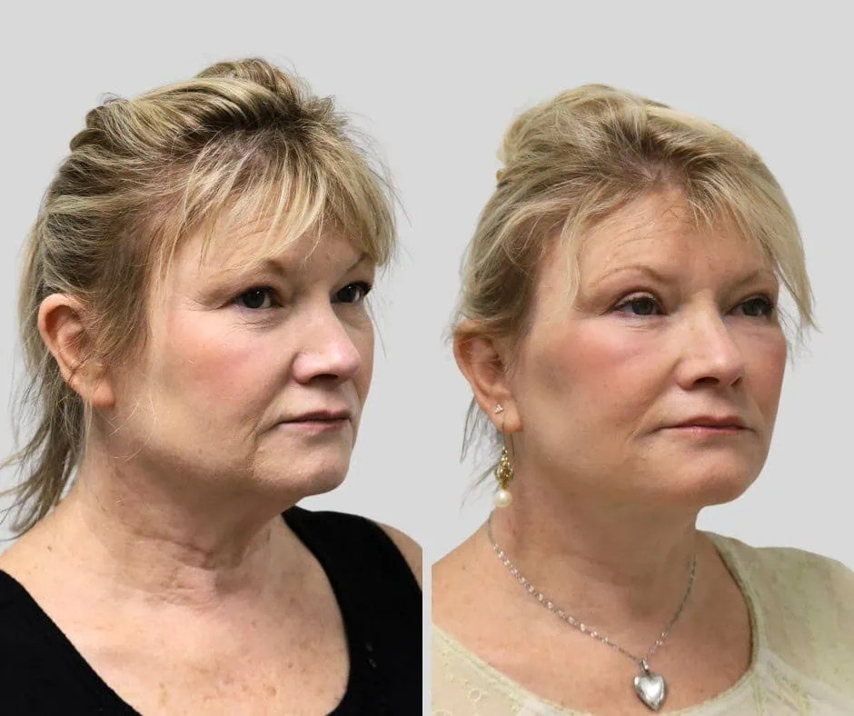 Age 55, right three-quarter view, before and after CURRENT Lift with fat grafting, upper blepharoplasty and periocular laser, 1 year post-op
