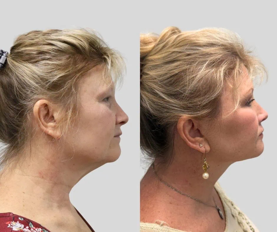 Age 55, right profile, before and after CURRENT Lift with fat grafting, upper blepharoplasty and periocular laser, 1 year post-op