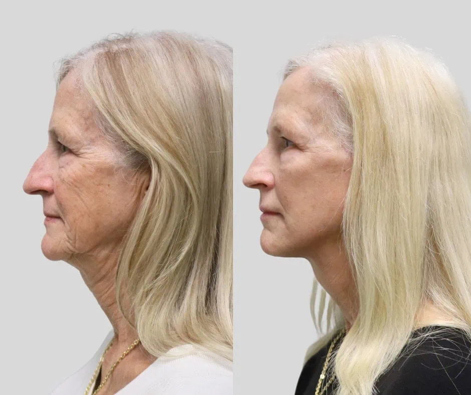 Age 65, left profile, before and after CURRENT Lift with fat grafting and temporal brow lift, 6 months post-op