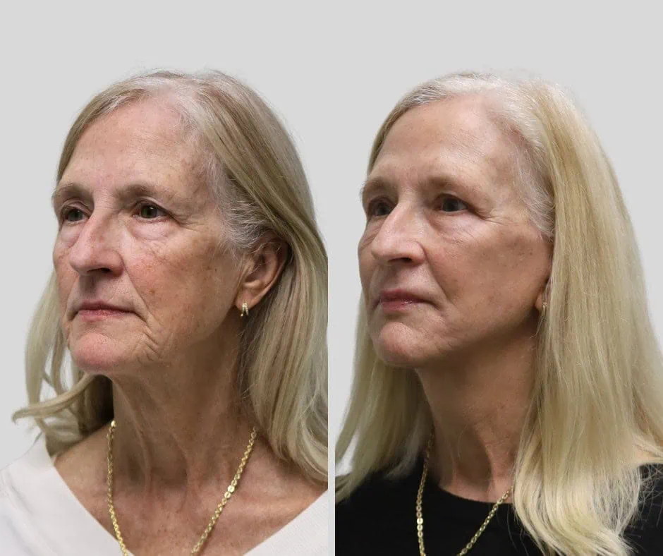 Age 65, left three-quarter view, before and after CURRENT Lift with fat grafting and temporal brow lift, 6 months post-op