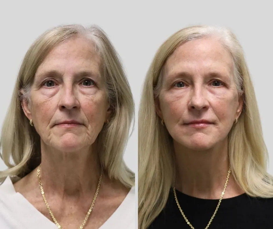 Age 65, front view, before and after CURRENT Lift with fat grafting and temporal brow lift, 6 months post-op