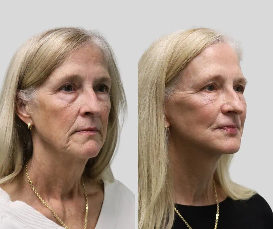 Age 65, right three-quarter view, before and after CURRENT Lift with fat grafting and temporal brow lift, 6 months post-op