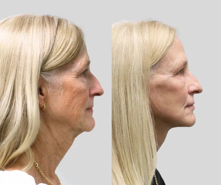 Age 65, right profile, before and after CURRENT Lift with fat grafting and temporal brow lift, 6 months post-op