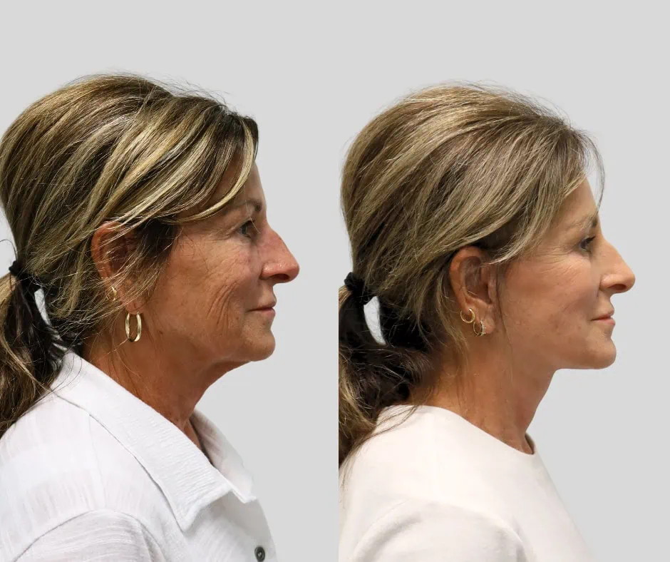 Age 68, right profile, before and after CURRENT Lift with upper blepharoplasty, 6 months post-op
