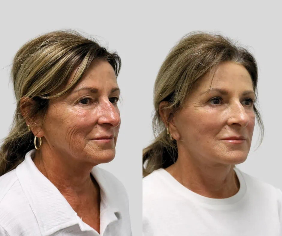 Age 68, front view, before and after CURRENT Lift with upper blepharoplasty, 6 months post-op
