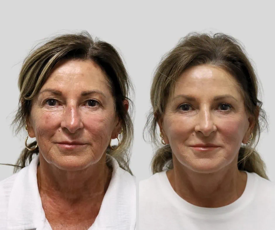 Age 68, right three-quarter view, before and after CURRENT Lift with upper blepharoplasty, 6 months post-op