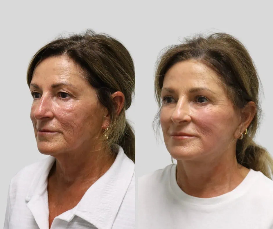Age 68, left three-quarter view, before and after CURRENT Lift with upper blepharoplasty, 6 months post-op