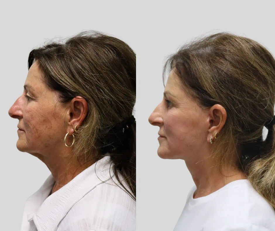 Age 68, left profile, before and after CURRENT Lift with upper blepharoplasty, 6 months post-op