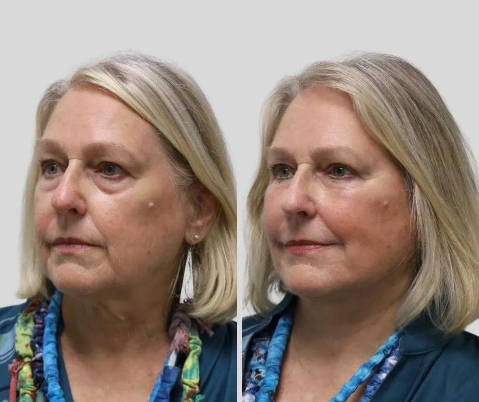 Age 75, left three-quarter view, before and after CURRENT Lift with temporal brow lift, upper blepharoplasty and periocular fat grafting, 6 months post-op