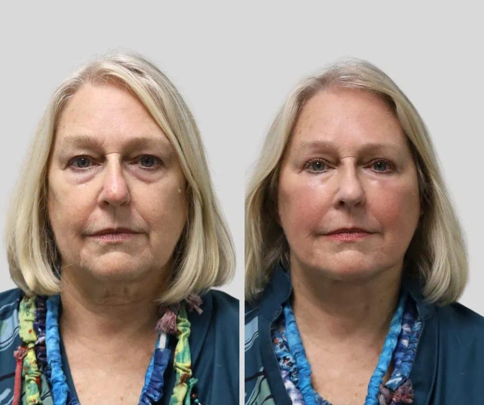 Age 75, front view, before and after CURRENT Lift with temporal brow lift, upper blepharoplasty and periocular fat grafting, 6 months post-op