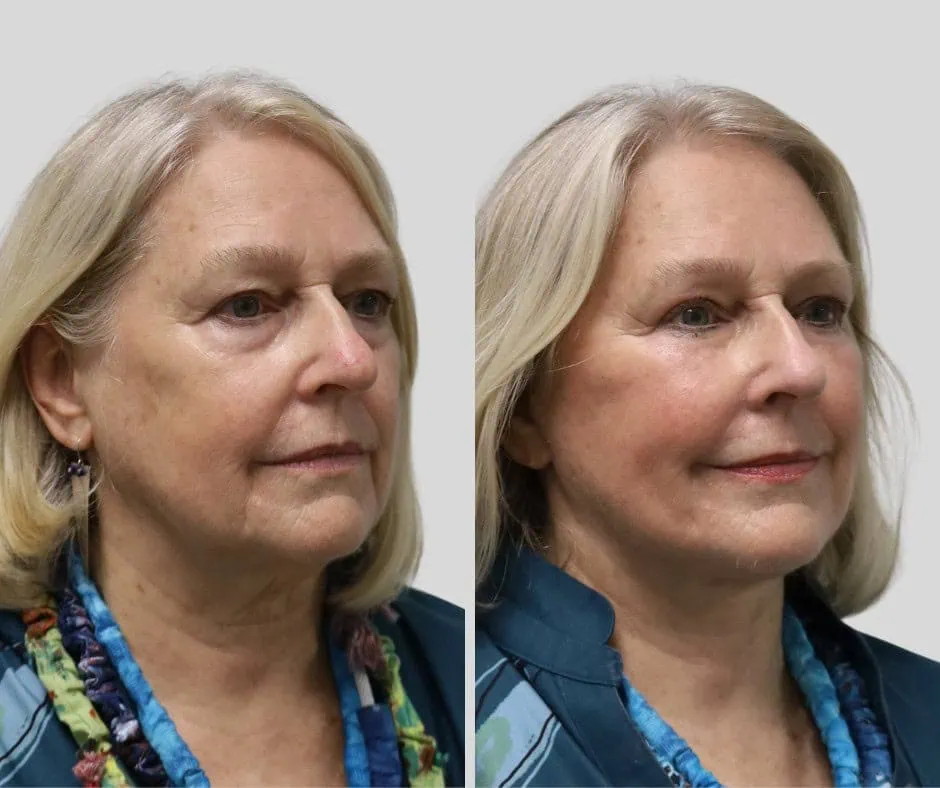 Age 75, right three-quarter view, before and after CURRENT Lift with temporal brow lift, upper blepharoplasty and periocular fat grafting, 6 months post-op