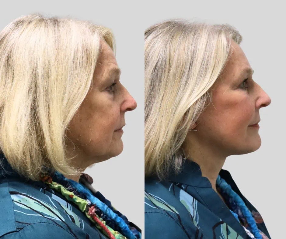 Age 75, right profile, before and after CURRENT Lift with temporal brow lift, upper blepharoplasty and periocular fat grafting, 6 months post-op